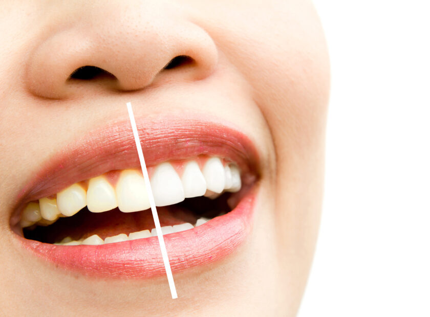 woman teeth before and after whitening. Over white background
